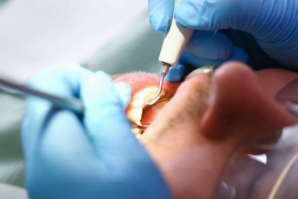 Best Emergency Root Canal Treatment in Bettendorf, IA