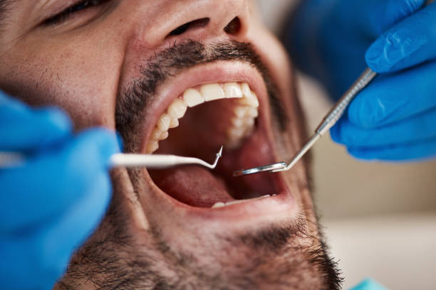 Best Emergency Tooth Extraction in Bettendorf, IA