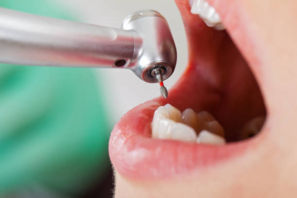 Best Emergency Broken Tooth Repair in Bettendorf, IA